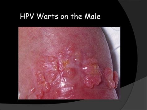 can youget hpv from oral sex sex archive