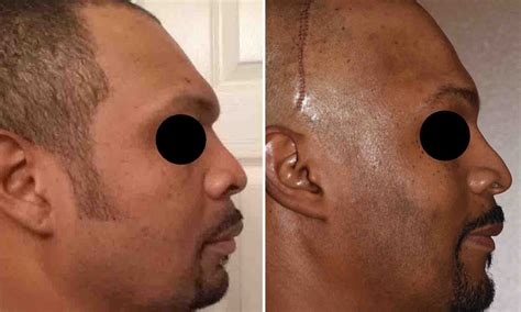 plastic surgery case study combined male brow bone reduction