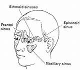 Sinus Sinusitis Pusing Penyakit Frontal Forehead Sering Cavities Gland Cheeks Fibrosis Cystic sketch template