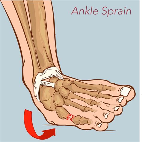 illustration showing  sprained ankle ankle sprain symptoms sprained