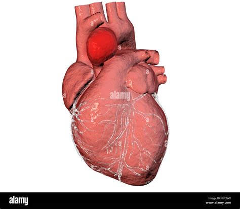 aortenaneurysma computer bild zeigt ein aneurysma  der aorta