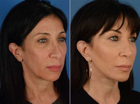 revision rhinoplasty photos page 2 of 2 aesthetic