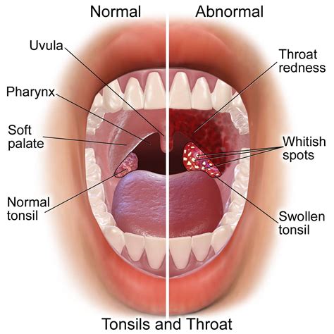 everything about strep throat istanbul dental care