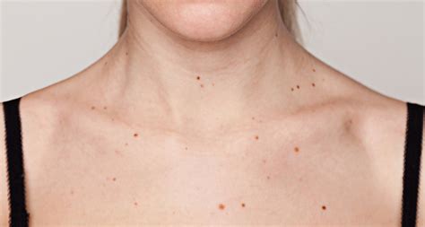 Number Of Skin Moles Tied To Breast Cancer Risk