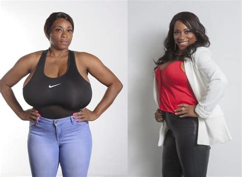 biggest natural breasts in texas woman has 36jjj breast reduction