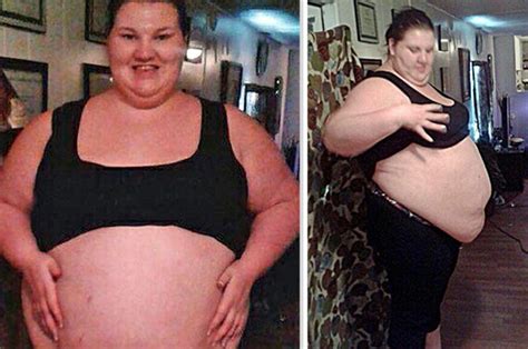 Obese Woman Who Gorged On 11 000 A Day Loses 17st After Having Gastric