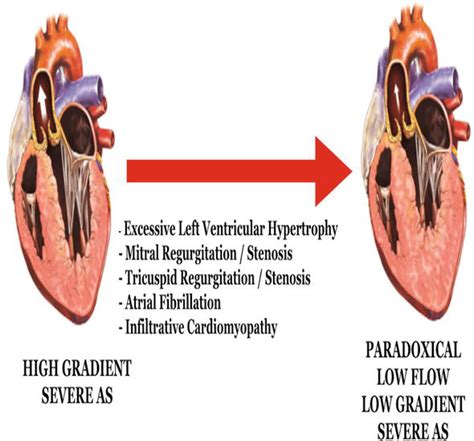 Low Flow Low Gradient Severe Aortic Stenosis Diagnosis