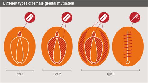 Female Genital Mutilation What Is It And Can It Be