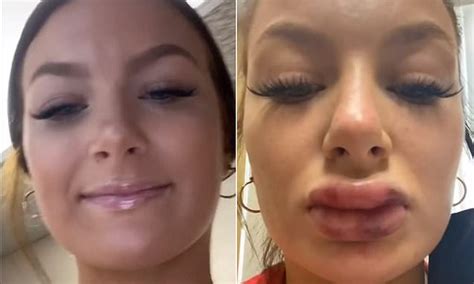 woman shares shocking video of her swollen and bruised lips after she