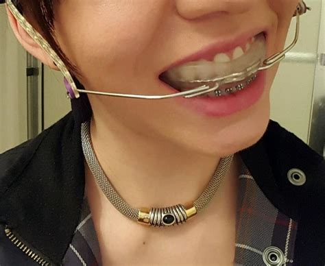 Braces Girlswithbraces Metalbraces Headgear