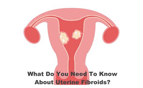 What Do You Need To Know About Uterine Fibroids