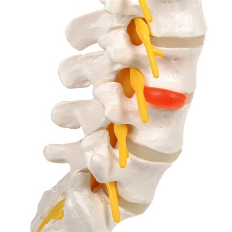 Anatomical Lumbar Spinal Column With Prolapsed Intervertebral Disc Model