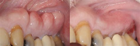 treatment  excessive bony growths exostosis tori   jaw bone