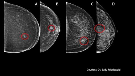 screening algorithms in dense breasts youtube