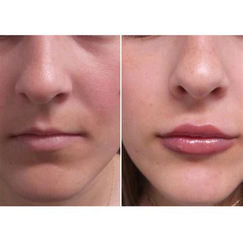 tacoma laser clinic   lip enhancement treatment