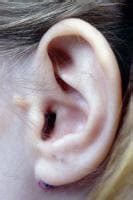 preauricular cysts pits  fissures