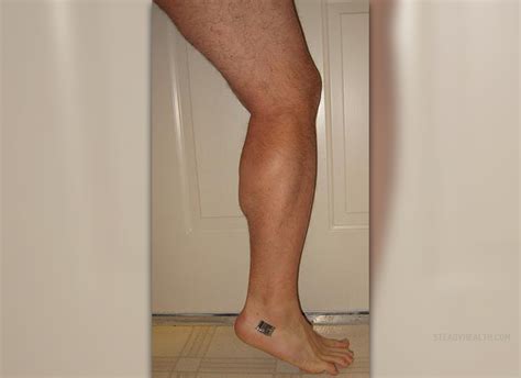 swollen calf muscle musculoskeletal issues articles body health conditions center