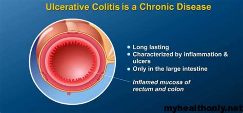 inflammation   small intestine ulcerative colitis