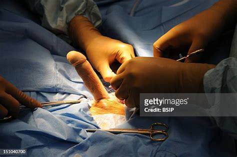 phalloplasty photos et images de collection getty images