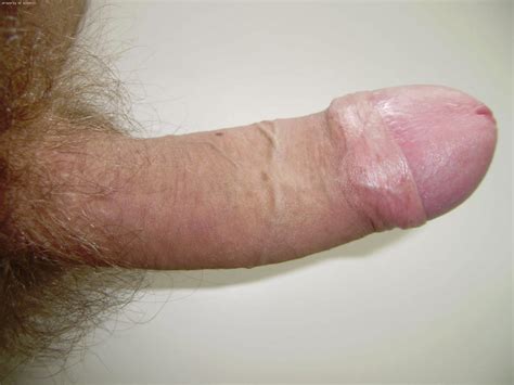foreskin too tight