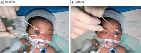 Ophthalmic Manifestations Of Congenital Zika Syndrome In Colombia And