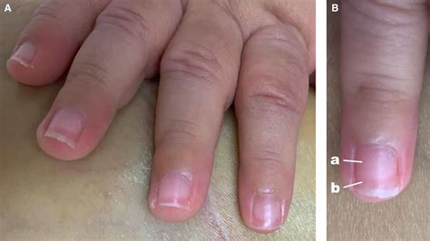 terry s nails in an infant with liver cirrhosis archives of disease