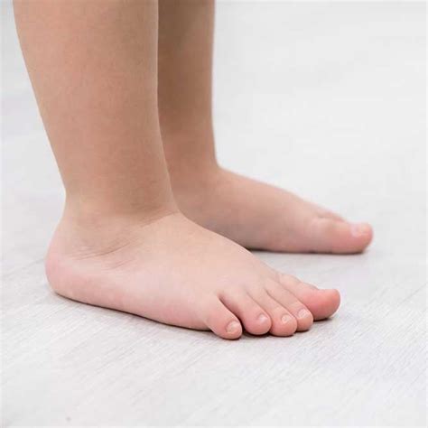 childrens flat feet   parent