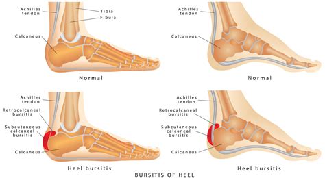bursitis  heel shuman podiatry sports medicine foot care