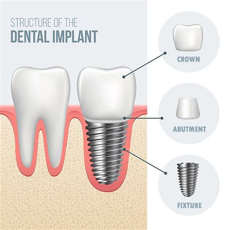 parts   dental implant oasis family dental