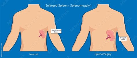 enlarged spleen splenomegaly disease reference guide  xxx hot girl