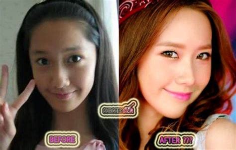 Yoona Snsd Gets Plastic Surgery Before And After Surgerystar