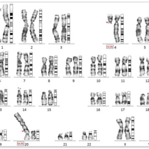 G Banded Karyotype Of The Female Patient Showing 46 Xx T 4 20 Q11 P13