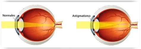Astigmatismo Eye Exams Optometrists Oxford And