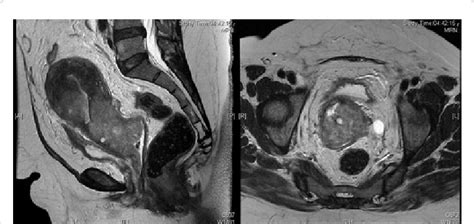 magnetic resonance imaging mri of pelvis showing 5 x 5 m cervical
