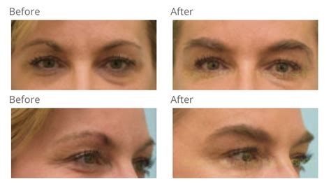 eyebrow restoration dallas brow surgery information plano tx