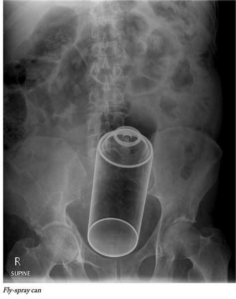 These X Rays Show That People Put Some Strange Items In Their Butts 8