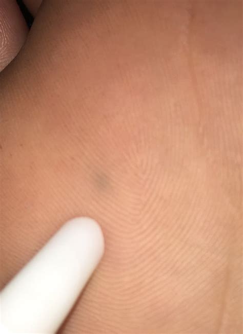 What Happens If A Thick Pencil Lead Remains Stuck Under Your Skin For