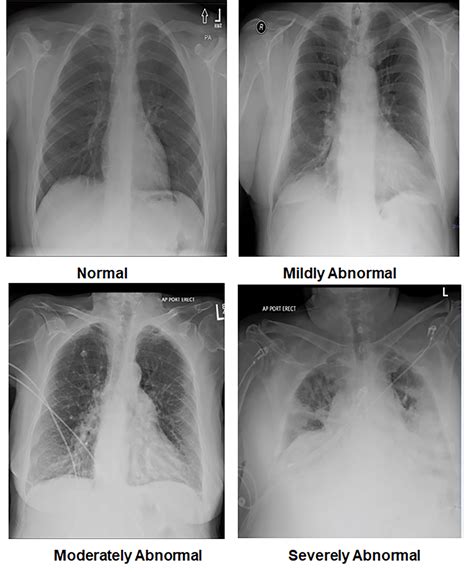 cureus covid   influenza  chest  ray comparison
