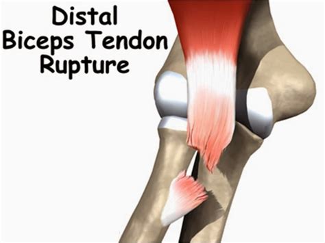 The Amazing Bodybuilding Biceps Tendon Rupture A Physical Therapists
