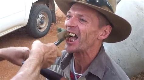 Bush Dentist Removes Two Rotten Teeth From A Man Using A Pair Of Pliers
