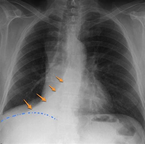 Right Lower Lobe Collapse Radiology Case