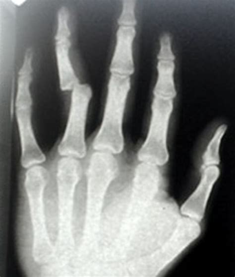 broken finger symptoms diagnosis healing time treatment hubpages