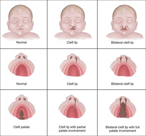 Brush Up On Your Knowlege Of Cleft Palates With Great Web Resources