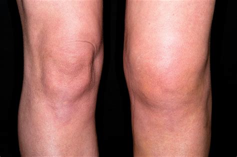 natural and medical ways to remove knee fluid med