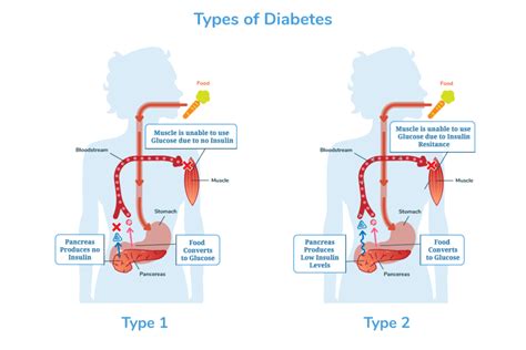 comprehensive guide  diabetes aginginplaceorg