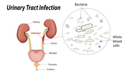 Urinary Tract Infections Utis Symptoms And Causes Life
