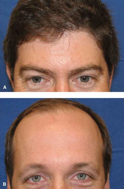 forehead plastic surgery key