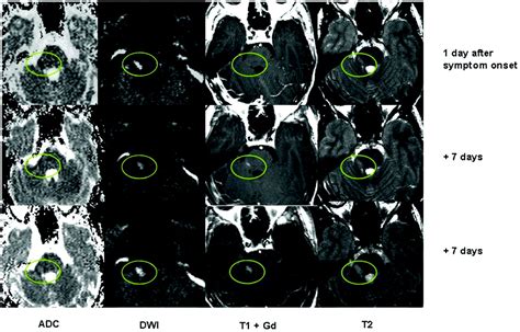 Reduced Diffusion In A Subset Of Acute Ms Lesions A Serial