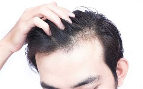penyebab   mengatasi rambut lepek  pria