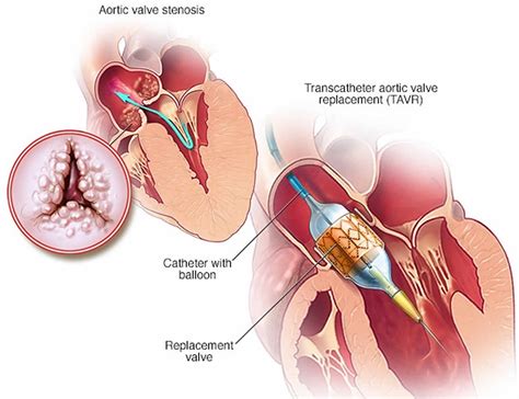 Aortic Stenosis Causes Symptoms Diagnosis Treatment